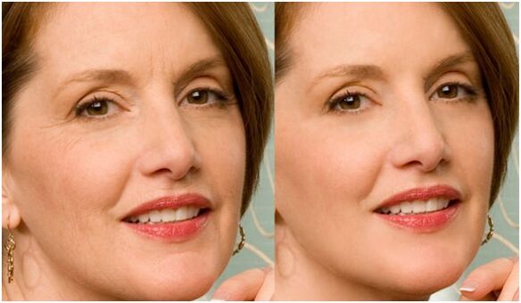 pred in po pomlajevanju plazemske kože obraza