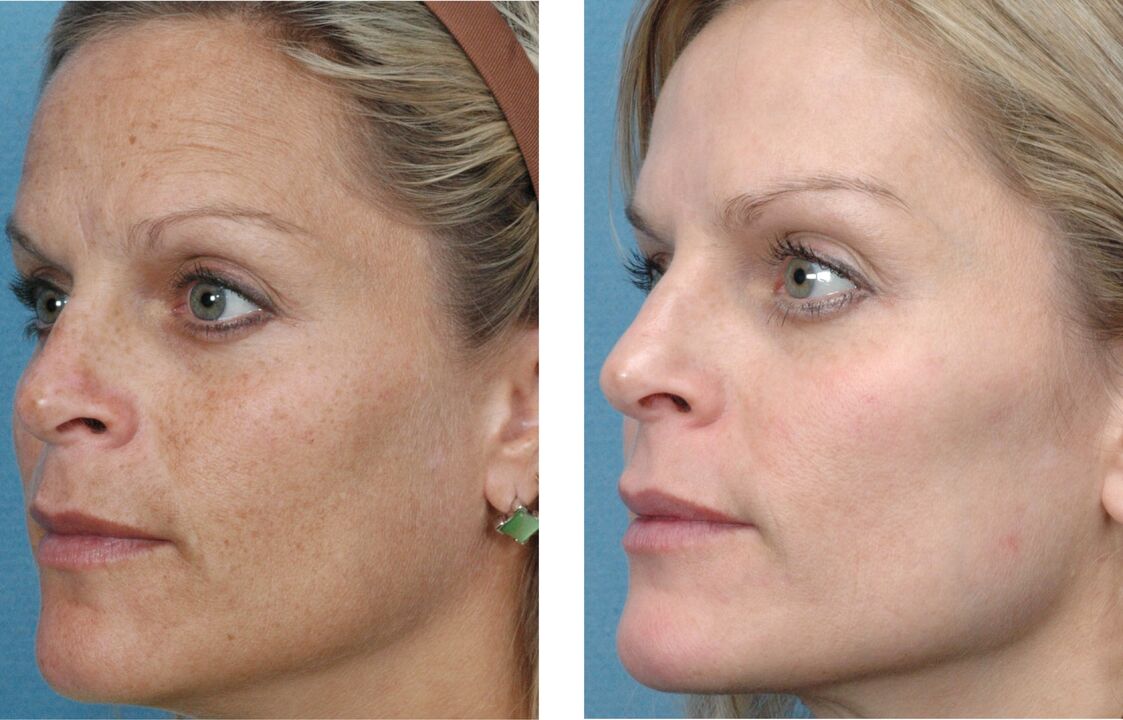 fotografija pred in po pomlajevanju kože 1