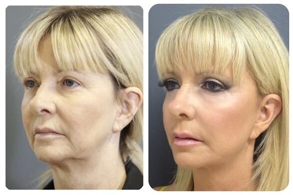 pred in po pomlajevanju kože z zategovalno fotografijo 2