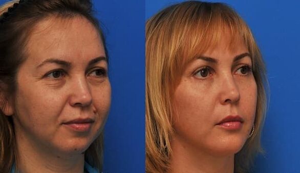 pred in po pomlajevanju kože z zategovanjem fotografija 1