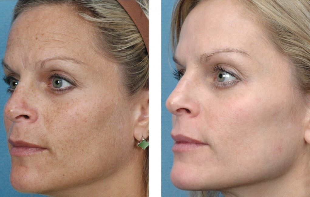 pred in po pomlajevanju kože