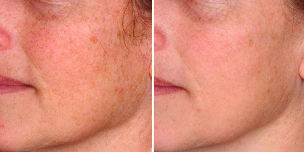 Rezultat frakcijske fototermolize je zmanjšanje starostnih peg na koži obraza. 
