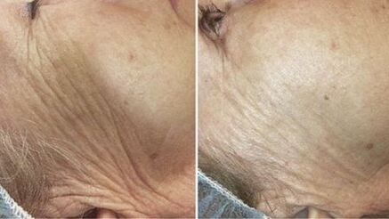 pred in po laserskem pomlajevanju kože