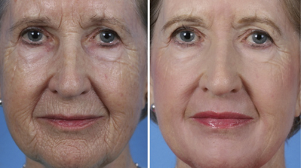 delno pomlajevanje obraza pred in po fotografijah
